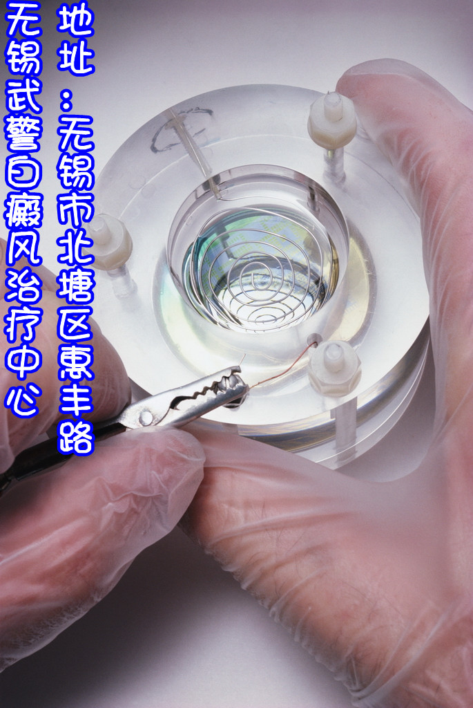 白癜风徐州治疗日常生活中多加注意细节无锡武@警白癜风治疗中心