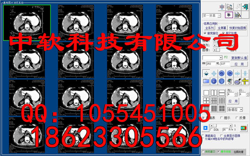 CT工作站CT影像软件X线工作站DR软件CR软件